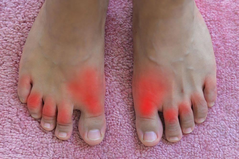 All you need to Know about Gout and Its Treatment